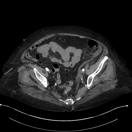 File:Active renal extravasation with large subcapsular and retroperitoneal hemorrhage (Radiopaedia 60975-68796 Axial C+ arterial phase 160).jpg