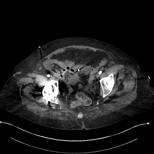 Active renal extravasation with large subcapsular and retroperitoneal hemorrhage (Radiopaedia 60975-68796 Axial C+ arterial phase 177).jpg