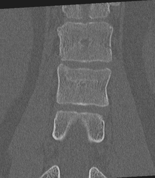 Acute L1 burst compression fracture (Radiopaedia 34430-35755 Coronal bone window 33).png