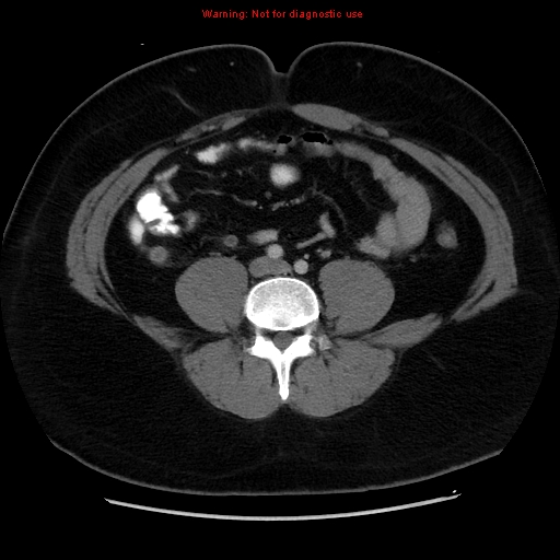 File:Acute appendicitis (Radiopaedia 12326-12607 Axial C+ portal venous phase 16).jpg