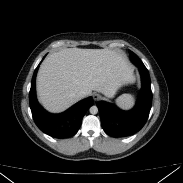 Acute appendicitis (Radiopaedia 38255-40270 Axial C+ portal venous phase 11).jpg