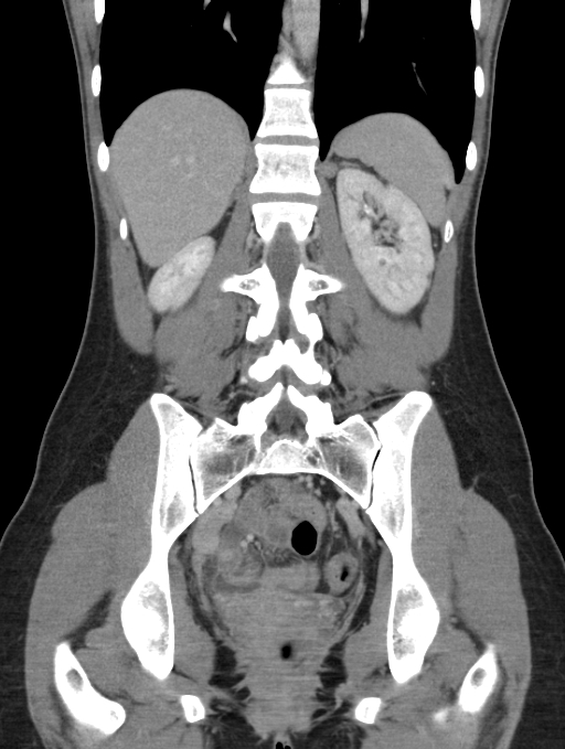 Acute appendicitis (Radiopaedia 62608-70901 Coronal C+ portal venous phase 39).jpg