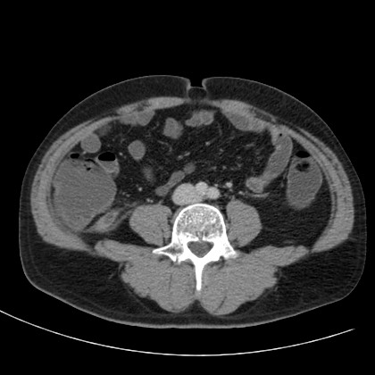 Acute appendicitis (Radiopaedia 66513-75790 Axial C+ portal venous phase 50).jpg