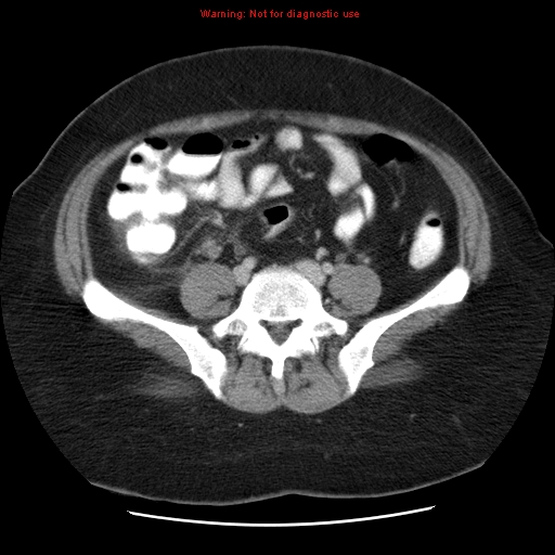 Acute appendicitis complicated by ovarian vein thrombophlebitis (Radiopaedia 16172-15851 Axial C+ portal venous phase 63).jpg