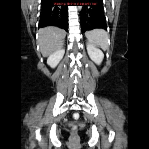 File:Acute appendicitis complicated by ovarian vein thrombophlebitis (Radiopaedia 16172-15851 Coronal C+ portal venous phase 62).jpg