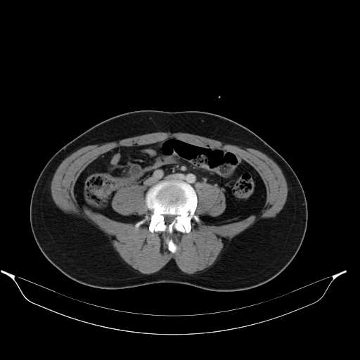 File:Acute appendicitis with appendicoliths (Radiopaedia 21148-21062 Axial C+ portal venous phase 7).jpg