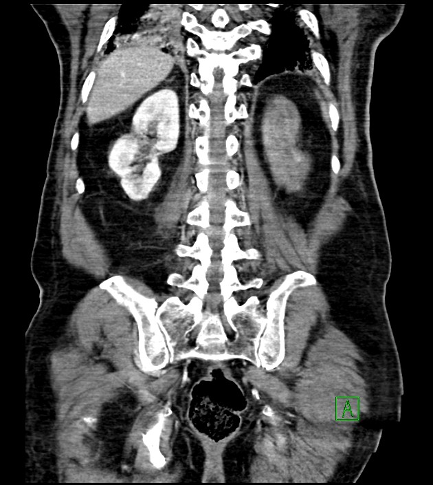 Acute arterial mesenteric ischemia (Radiopaedia 78238-90828 Coronal C+ portal venous phase 70).jpg
