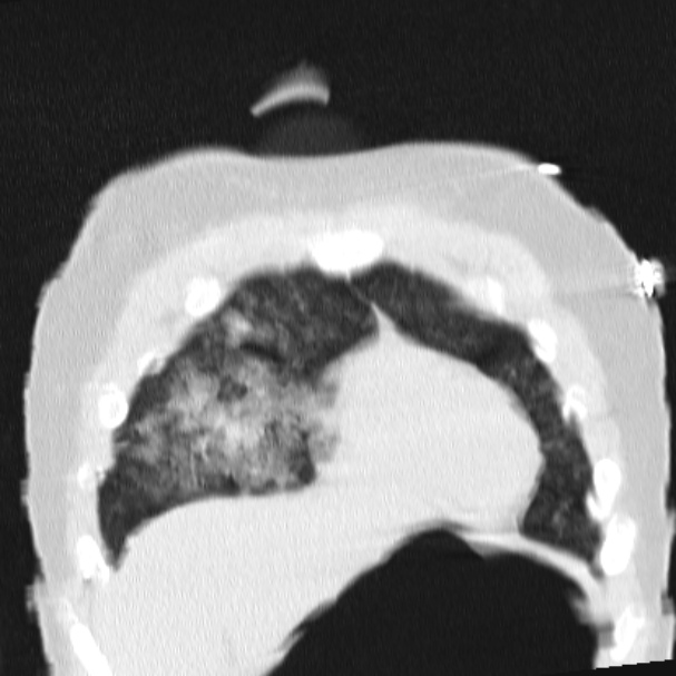 Acute aspiration pneumonitis (Radiopaedia 33605-34703 Coronal lung window 20).jpg