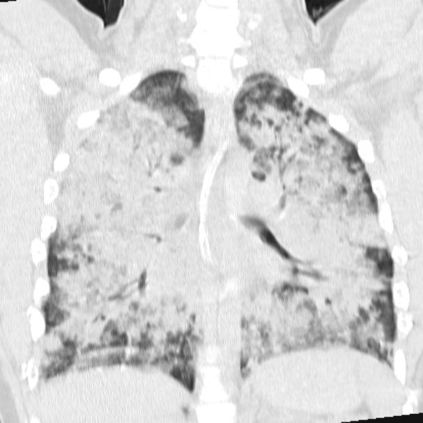 Acute aspiration pneumonitis (Radiopaedia 33605-34703 Coronal lung window 51).jpg
