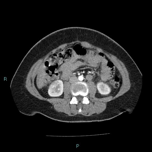 Acute bilateral pyelonephritis (Radiopaedia 37146-38881 Axial C+ arterial phase 102).jpg