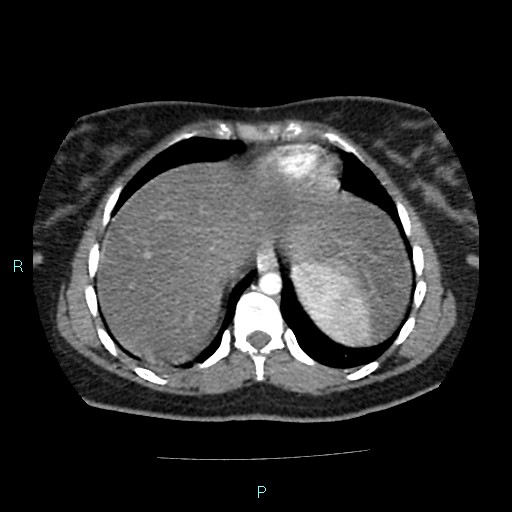 Acute bilateral pyelonephritis (Radiopaedia 37146-38881 Axial C+ arterial phase 14).jpg