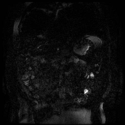 Acute cholecystitis and biliary hamartomas (Radiopaedia 86231-102240 E 140).jpg