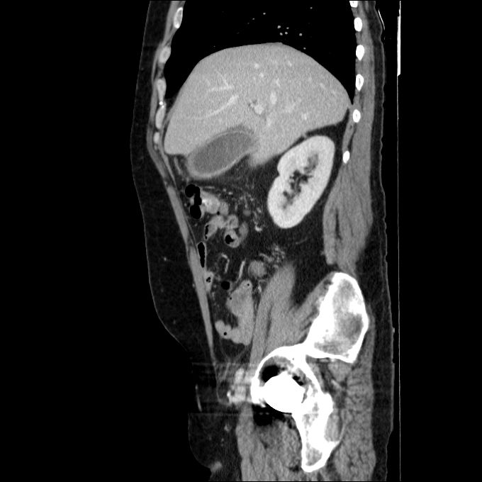 Acute cholecystitis and incidental left sided IVC (Radiopaedia 49352-54459 Sagittal C+ portal venous phase 63).jpg