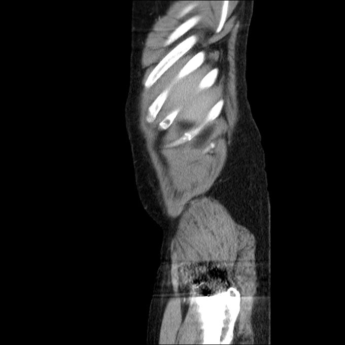 Acute cholecystitis and incidental left sided IVC (Radiopaedia 49352-54459 Sagittal C+ portal venous phase 82).jpg