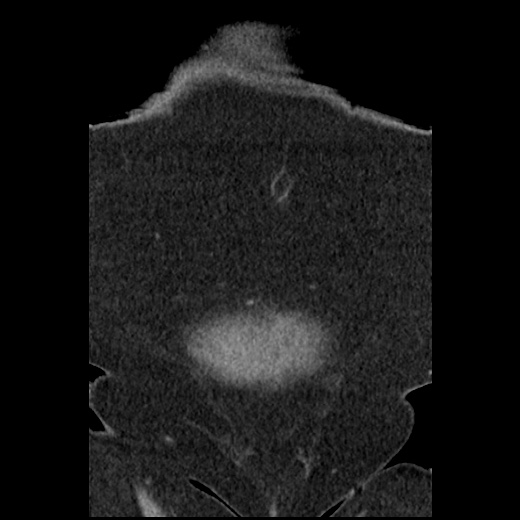 Acute cholecystitis and ureteric colic (Radiopaedia 42330-45444 Coronal prone 15).jpg