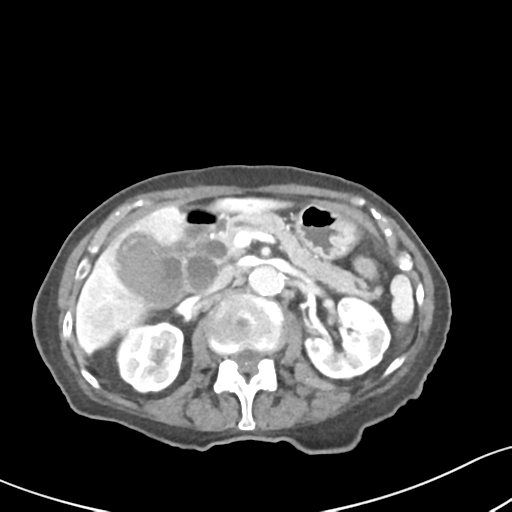 File:Acute cholecystitis with contained perforation (Radiopaedia 47328-51907 Axial C+ portal venous phase 27).png