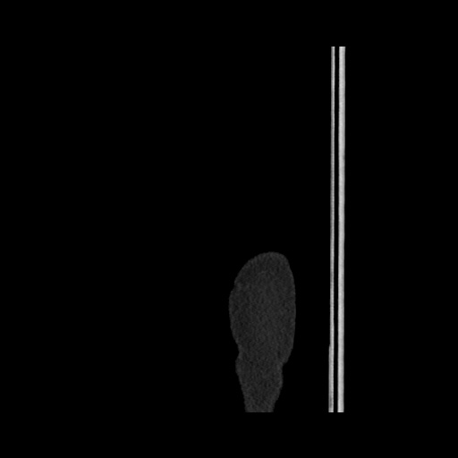Acute cholecystitis with tensile fundus sign (Radiopaedia 71394-81723 Sagittal non-contrast 6).jpg