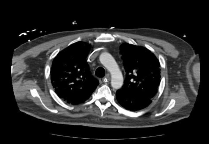 Acute cor pulmonale (ultrasound) (Radiopaedia 83508-98818 Axial C+ CTPA 20).jpg