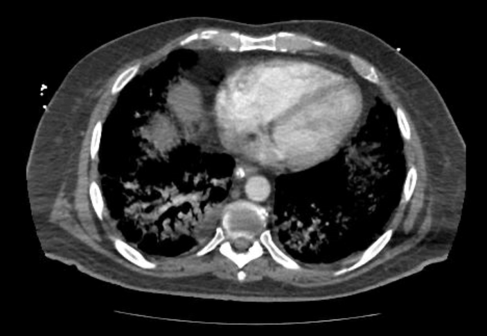 Acute cor pulmonale (ultrasound) (Radiopaedia 83508-98818 Axial C+ CTPA 56).jpg