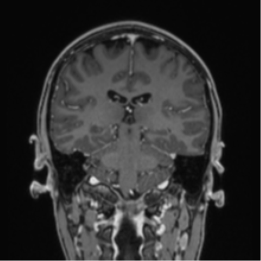 Acute disseminated encephalomyelitis (ADEM) (Radiopaedia 65319-74349 Coronal T1 C+ 16).png