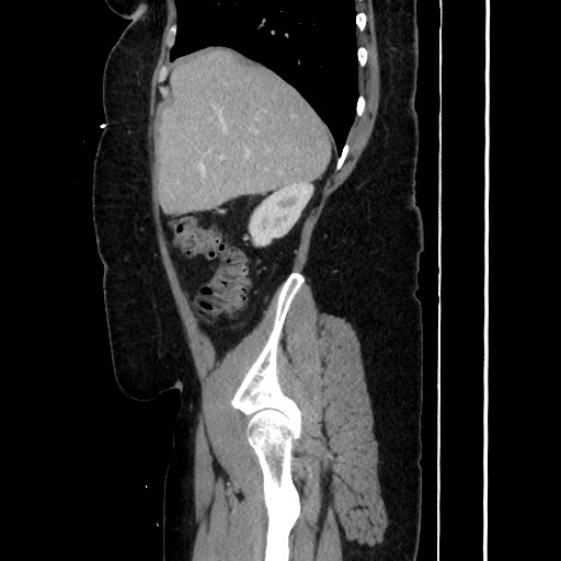 Acute diverticulitis - transverse colon (Radiopaedia 87063-103327 Sagittal C+ portal venous phase 76).jpg