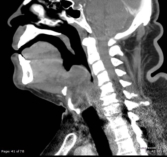 Acute epiglottitis (Radiopaedia 54375-60590 Sagittal C+ arterial phase 41).jpg