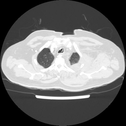 File:Acute heart failure (CT) (Radiopaedia 79835-93075 Axial lung window 5).png