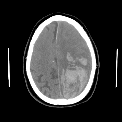 File:Acute hemorrhagic stroke (Radiopaedia 17507-17223 Axial non-contrast 39).jpg