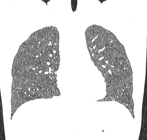 Acute hypersensitivity pneumonitis (Radiopaedia 85293-100870 Coronal lung window 49).jpg