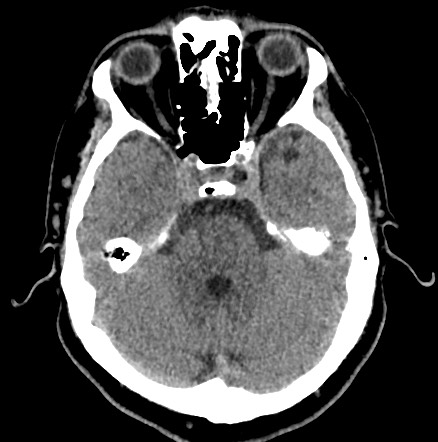 File:Acute internal carotid artery dissection (Radiopaedia 53541-59558 Axial non-contrast 18).jpg