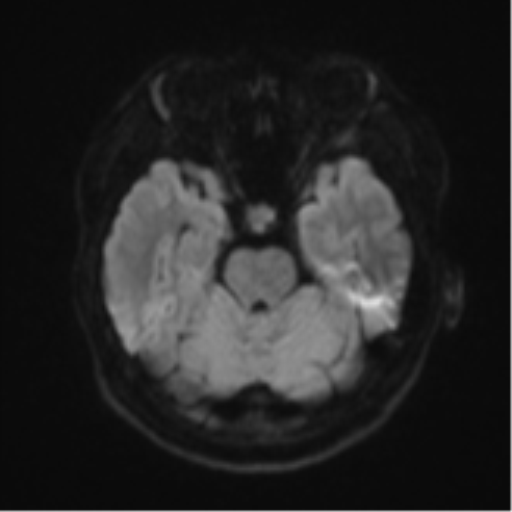 Acute left middle cerebral artery territory infarct with clot retrieval (Radiopaedia 47732-52433 Axial DWI 40).png