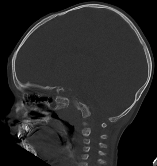 Acute mastoiditis (Radiopaedia 82678-96881 Sagittal bone window 28).jpg