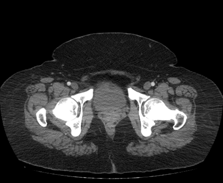 Acute mesenteric ischemia (Radiopaedia 80029-93316 Axial C+ arterial phase 132).jpg