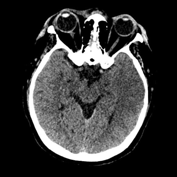 Acute middle cerebral artery territory infarct (Radiopaedia 52380-58283 Axial non-contrast 41).jpg