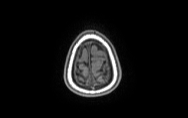 Acute necrotizing encephalitis of childhood (Radiopaedia 67356-76737 Axial T1 5).jpg
