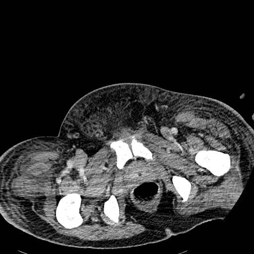 Acute pancreatic necrosis (Radiopaedia 13560-18501 Axial C+ portal venous phase 151).jpg