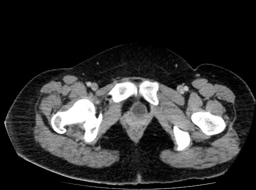 Acute pancreatitis (Radiopaedia 69236-79012 Axial C+ portal venous phase 89).jpg