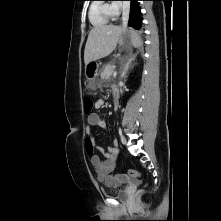 Acute pancreatitis (Radiopaedia 69236-79012 Sagittal C+ portal venous phase 47).jpg