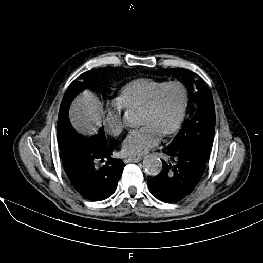 File:Acute pancreatitis (Radiopaedia 85146-100701 Axial non-contrast 11).jpg