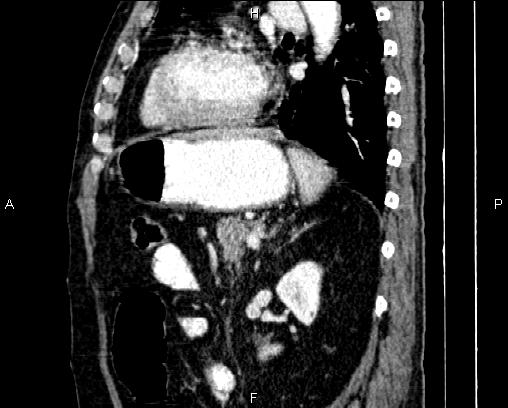 File:Acute pancreatitis (Radiopaedia 85146-100701 Sagittal C+ portal venous phase 63).jpg