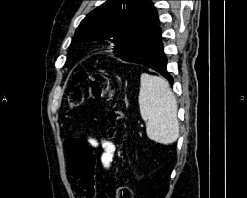 Acute pancreatitis (Radiopaedia 85146-100701 Sagittal C+ portal venous phase 82).jpg