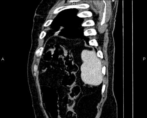 Acute pancreatitis (Radiopaedia 85146-100701 Sagittal C+ portal venous phase 86).jpg