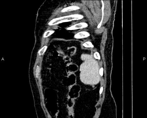 Acute pancreatitis (Radiopaedia 85146-100701 Sagittal C+ portal venous phase 88).jpg