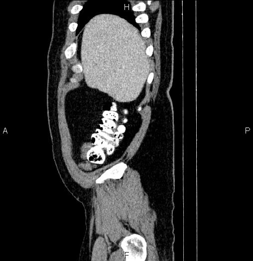 Acute pancreatitis (Radiopaedia 85390-101010 Sagittal C+ portal venous phase 7).jpg