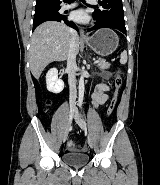 Acute pancreatitis (Radiopaedia 87428-103757 Coronal C+ portal venous phase 51).jpg