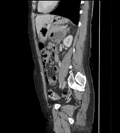 File:Acute pancreatitis - Balthazar E - post ERCP (Radiopaedia 27562-27772 Sagittal C+ portal venous phase 89).png
