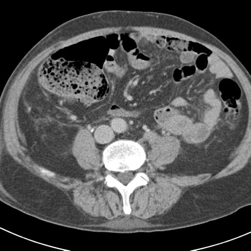 Acute pancreatitis and walled-off necrosis (Radiopaedia 29888-30403 Axial C+ delayed 52).jpg