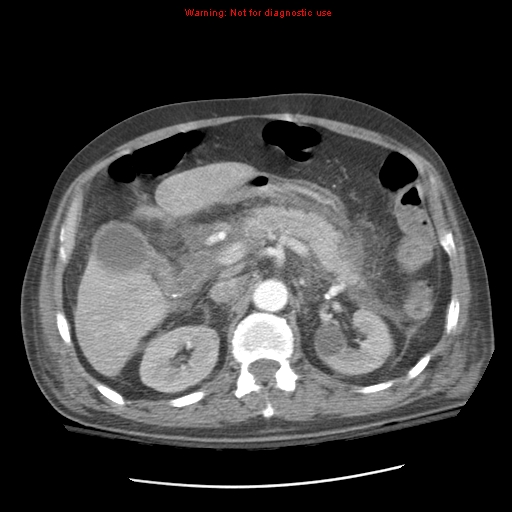 Acute pancreatitis with incidental pancreatic lipoma (Radiopaedia 10190-10730 Axial C+ arterial phase 36).jpg