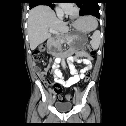 File:Acute pancreatitis with walled off pancreatic necrosis (Radiopaedia 6438-7797 Coronal C+ portal venous phase 4).jpg