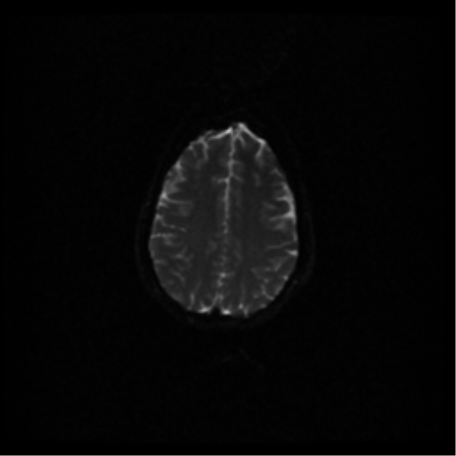 File:Acute pontine infarct from vertebral artery dissection (Radiopaedia 34111-35370 Axial DWI 41).png